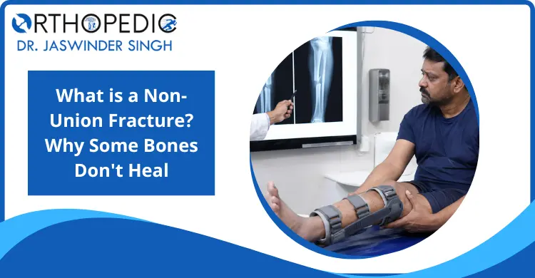 what-is-a-non-union-fracture-why-some-bones-dont-heal